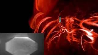 Medical Imaging Registration of Angiographic Images [upl. by Cynthia634]