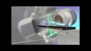 Spine Tumor Treatment  Truebeam STx  Phoenix CyberKnife [upl. by Ahcilef]