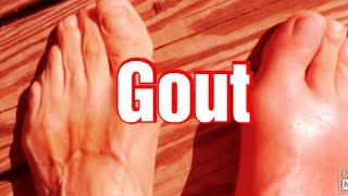 Gout Biochemistry  Types of Gout Treatment of Gout Hyperuricemia [upl. by Hansiain]