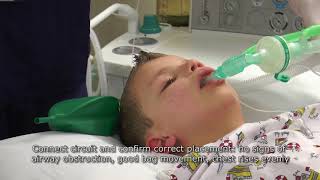 Paediatric Anaesthetics Chapter 2  LMA insertion 1 [upl. by Ananna]