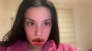 LIP FILLER GONE WRONG 🥵😷🤐lipfiller botched regret evilsurgeon medicalfails edgingforgang [upl. by Idnam]