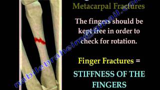 Finger and metacarpal Fractures  Everything You Need To Know  Dr Nabil Ebraheim [upl. by Montagu]