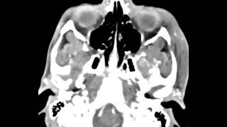 Mandibular Condyle Osteochondroma [upl. by Ewens581]