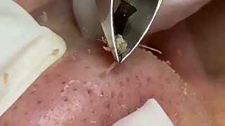 Tweezer Triumph Massive Nose Blackhead Removal [upl. by Inaluahek]