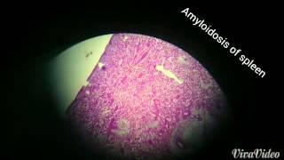 Spleen amyloidosis [upl. by Anahs402]