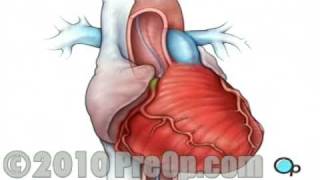 Heart Health Cardiac Catheterization Surgery PreOp® Patient Education [upl. by Ocisnarf]