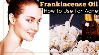 Frankincense Essential Oil for Acne How to Use It [upl. by Nortna]