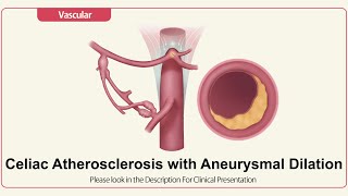 Celiac Atherosclerosis with Aneurysmal Dilation [upl. by Hgielram838]