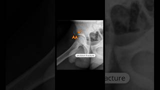 right anterior inferior iliac spine avulsion fracture xray shortsfeed [upl. by Ecneralc985]