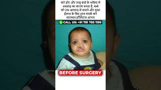 Cleft Lip and Palate Surgery at Saraswat Hospital at Agra [upl. by Vernor]