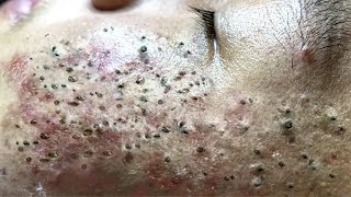 Blackhead Removal With Sac Dep Spa 100074091 [upl. by Wirth383]