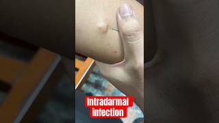 intradermal injection  intradermoterapia  subscribe medicalequipment cannula baby [upl. by Maureen]