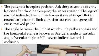 Buerger’s postural test for lower limb ischemia [upl. by Wolfie]