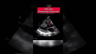 VSD with Eisenmenger Syndrome echocardiography echocardiogram echo shorts [upl. by Kenway]