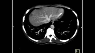 Abdomen Liver Cavernous Hemangioma of the Liver9 of 9 [upl. by Arel587]