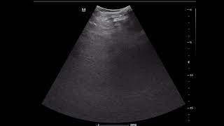 CASE 1094 CONGESTIVE HEPATOPATHY [upl. by Aitam393]