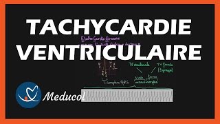 Tachycardie Ventriculaire ECG symptômes et traitement [upl. by Anitsrhc775]