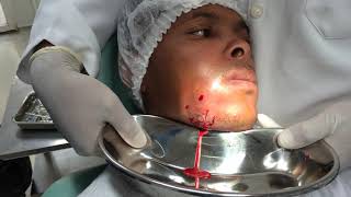 Drenagem de abcesso submandibular com acesso extra oral [upl. by Arocet]