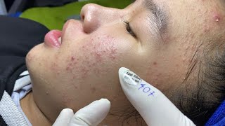 Acne treatment for Spa Linh Mun 2023 111 [upl. by Kakalina]