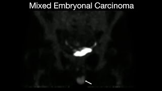 Mixed Embryonal Carcinoma [upl. by Sucerdor]