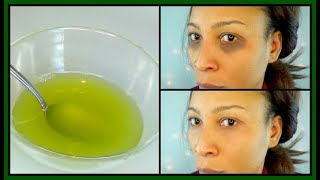 HOW TO GET RID OF DARK CIRCLES UNDER THE EYES EYE BAGS PUFFY EYES  ITCHING EYES Khichi Beauty [upl. by Therine700]