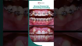 Braces Process for Correcting Crowding [upl. by Melony]