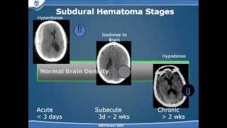 Traumatic Brain Injury Part 2 [upl. by Aicinod288]