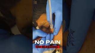 Mole Removal in MINUTES with Dr Kasanas Proven Methods [upl. by Jule]