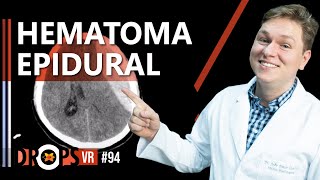 HEMATOMA EPIDURAL – COMO RECONHECER E PORQUE OCORRE [upl. by Ahsirahc]