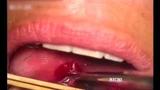 Drenaje de un absceso periamigdalino  Peritonsillar abscess drainage [upl. by Jaenicke769]