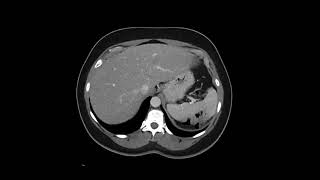 Retroperitoneal Leiomyosarcoma [upl. by Nomsed]