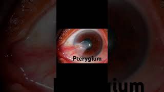 Pterygium  learn and revise a very potential mcq ytshorts ytindia yt eyes [upl. by Silecara808]