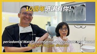 Periodontal Waterlase treatment regenerate new bone New tech in gum disease [upl. by Keryt]