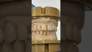 Central Monet Pure Zirconia Crown EnvisiontecMain envisiontec lsk121shorts dentistteeth [upl. by Icak]