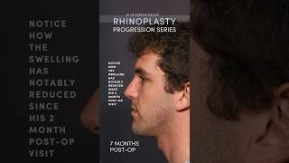 Check out this Rhinoplasty Progression by Dr Kiersten Riedler 😍 [upl. by Helfant]