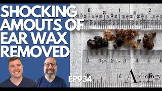 SHOCKING AMOUNTS OF EAR WAX REMOVED  EP934 [upl. by Andris]