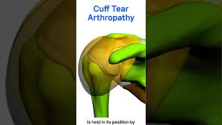 Rotator Cuff Tear Arthropathy [upl. by Llydnek]