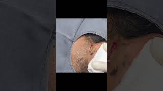 An Ear Cyst You Dont Want to Miss [upl. by Arraek]