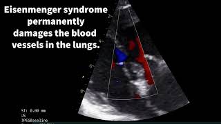 Eisenmenger syndrome [upl. by Brocklin]