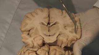 Cortical Localization Neuroanatomy Video Lab  Brain Dissections [upl. by Orvan345]