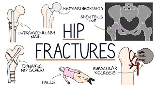 Understanding Hip Fractures and Hip Surgery [upl. by Inttirb782]