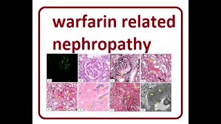 Warfarin Related Nephropathy  2024 [upl. by Airdnek927]