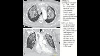 Daptomycin assoziierte eosinophile Pneumonitis [upl. by Mehetabel]