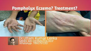 What is pompholyx eczema reason and Treatment of itchy vesiclesblisters on palms and soles [upl. by Cinderella]