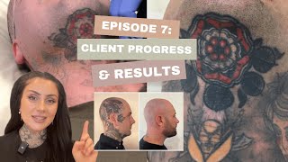 Laser Tattoo Removal Client Progress amp Results [upl. by Yelah]