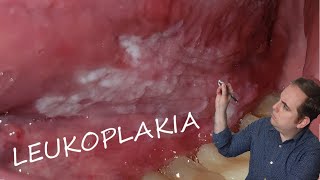 Leukoplakia Common Oral Pathology [upl. by Ermey320]