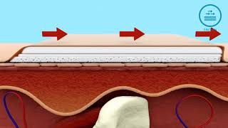 How Mepilex Border Dressing helps in Pressure Ulcer Prevention [upl. by Pfister]