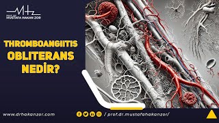 Thromboangiitis Obliterans Nedir Buerger Hastalığı [upl. by Ahdar811]