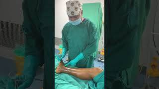 How LASER is used to treat varicose vein [upl. by Eittam699]