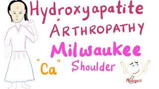 Hydroxyapatite Arthropathy  Milwaukee Soulder [upl. by Saile]